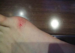 脚伤图片,从影像解读到全面恢复